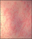 people measles9